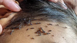 Getting out all hundred lice from his head - Remove thousand lice from hair