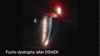 DSAEK endothelial corneal transplant for Fuchs corneal dystrophy