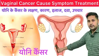 Vaginal Cancer Cause Symptoms Diagnosis Treatment Hindi | What is Vaginal Cancer | Vaginal Cancer