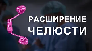 Расширение верхней челюсти. Отзыв