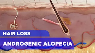 Hair Loss: Androgenic Alopecia