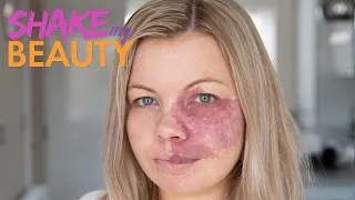 I Was Called 'Ugly' - But I Won't Hide My Birthmark Anymore | SHAKE MY BEAUTY