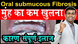 मुंह   का कम  खुलना कारण संपूर्ण इलाज oral submucous fibrosis I difficult to open mouth hind