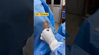 Continuous Thoracic spinal Anesthesia