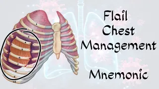 Flail Chest Management - Mnemonic | flail chest  | @medicoknowledge204