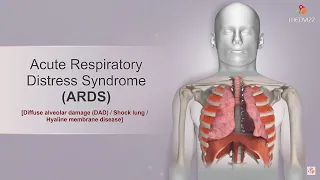 Acute respiratory distress syndrome ( ARDS ) Etiology, Clinical features, Diagnosis, and Treatment