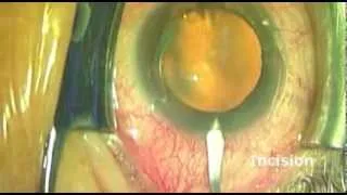 Schlemm's Canal Blood Congestion to visualize and identify Trabecular Meshwork  (1:48 min)