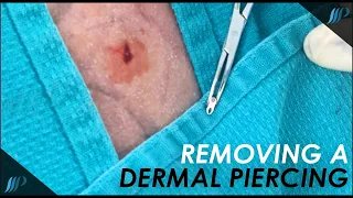 Getting a DERMAL PIERCING removed by a plastic surgeon