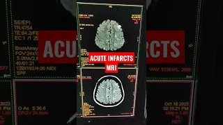 Acute Infarcts on MRI of Brain Stroke Protocol #shorts #viral