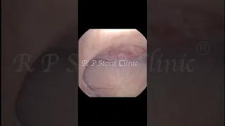 Small Kidney Stones Removed with RIRS.