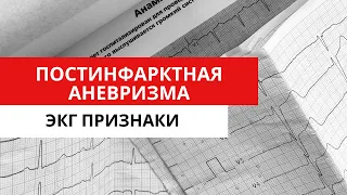 Осложнение инфаркта миокарда. Постинфарктная аневризма левого желудочка. ЭКГ диагностика.