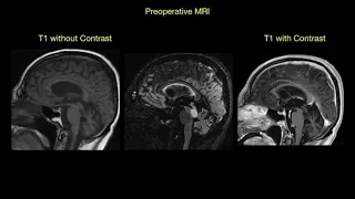 🧠 Midbrain Tectal Glioma