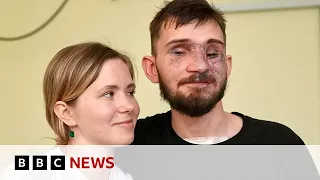 How Ukraine's war wounded repair their lives - BBC News