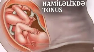 Hamiləlikdə tonus - Hansı halda təhlükəlidir?