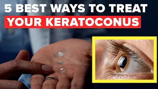 5 Best Ways to Treat Keratoconus Without Surgery