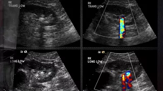 Imaging Urinary Stones: From the ER to the OR and Beyond