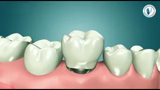 ماهي زراعة الاسنان الفورية | الدكتور منار حلواني