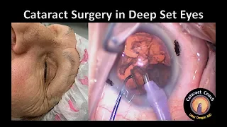 Cataract Surgery in Deep Set Eyes