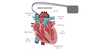 Pacemaker Issues Explained (Part 2): Decoding Undersensing