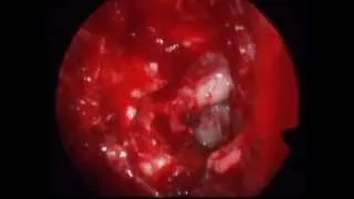 Endoscopic Excision of Sphenoethmoidal Cemento  ossifying fibroma