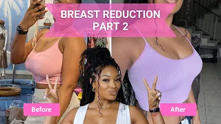 Breast Reduction Part 2 | Who was my Doctor?! | Before & After Photos