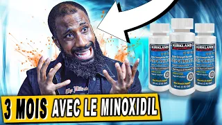 3 mois avec le MINOXIDIL pour ne plus avoir de CALVITIE