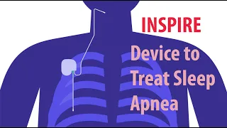 INSPIRE Device to Treat Sleep Apnea