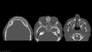 Agenesia de seios da face