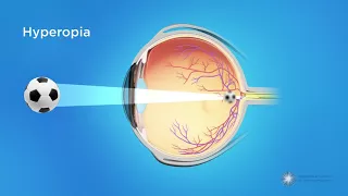 What is Hyperopia (Farsightedness)?