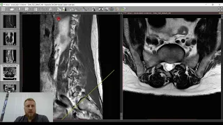 Научись читать МРТ. Поясничный отдел - базовый уровень