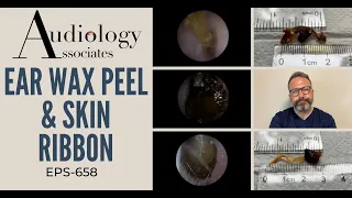 EAR WAX PEEL & SKIN RIBBON - EP658