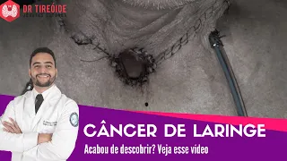 Câncer de laringe - Vídeo para quem acabou de descobrir! | Dr Jônatas Catunda