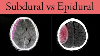 Subdural vs Epidural Hematoma/Hemorrhage [CT Scan Findings]