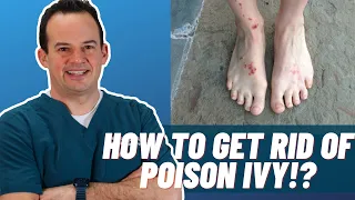 How to get rid of poison ivy | Dr. Nick Campitelli | #shorts