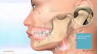 Carriere® Motion™ Appliance for Class II Patient Education Animation 2