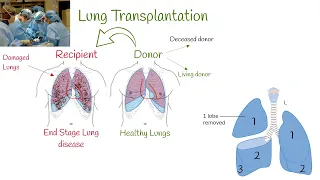 Lung Transplant Surgery, Survival, Organ Rejection. Risk-Benefit