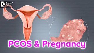 What happens if I have PCOS and I get pregnant? - Dr. Bala R