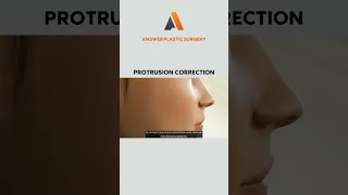 Protrusion Correction | Answer Plastic Surgery #shorts #protrusioncorrection