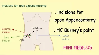 INCISIONS FOR OPEN APPENDECTOMY AND MC BURNEY'S POINT #appendectomy #appendixsurgery