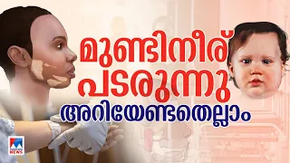 മുണ്ടിനീര് പടരുന്നു; രാജ്യമാകെ ആശങ്ക; ഡല്‍ഹിയില്‍ ജാഗ്രത | mumps|treatment | mumpssymptoms