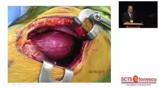 Management of the mediastinal mass