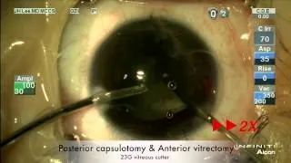 [HD] Traumatic cataract with corneal laceration in a 22 month baby