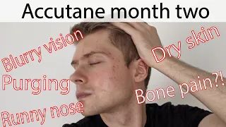 2 months on ACCUTANE for mild, stubborn acne | PURGING & SIDE EFFECTS