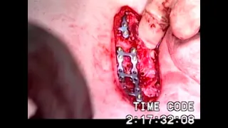 Modified Ravitch Procedure for Pectus Excavatum (Graphic)