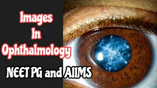 Images In Ophthalmology | NEET PG | AIIMS | PGI | FMGE