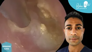 1,026 - Swimmer’s Ear Infection Removal (Normal & Reverse mode)