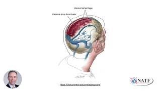 Cerebral Venous Sinus Thrombosis: A Patient Primer