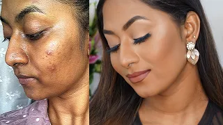 HOW TO COVER ACNE PRONE SKIN & HYPERPIGMENTATION ✨ | Flawless Full Coverage Base |