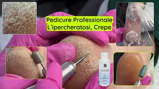 Pedicure Professionale Completo| L’ipercheratosi| CREPE| GEL ESFOLIANTE