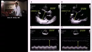 Imaging the Patient with Left Ventricular Assist Device (Jerry Estep, MD/Su Min Chang, MD)